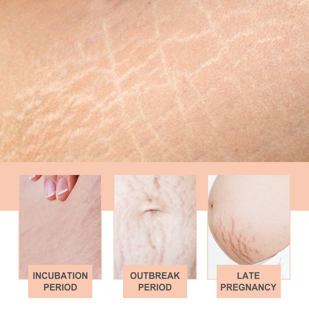 Snail Essence Pregnancy Stretch Mark Cream, Firming Skin Repair Lighten Postpartum Pregnancy Marks And Gestational Fat Smoothing Cream