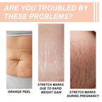 Snail Essence Pregnancy Stretch Mark Cream, Firming Skin Repair Lighten Postpartum Pregnancy Marks And Gestational Fat Smoothing Cream