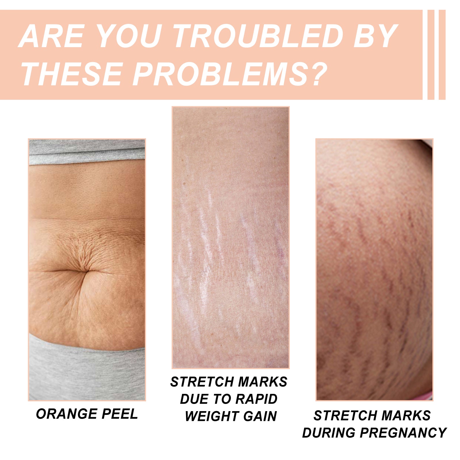 Snail Essence Pregnancy Stretch Mark Cream, Firming Skin Repair Lighten Postpartum Pregnancy Marks And Gestational Fat Smoothing Cream